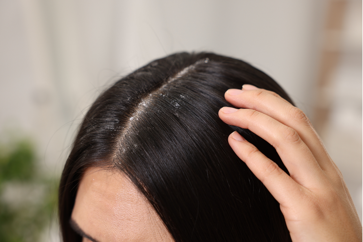 scalp treatment for dandruff