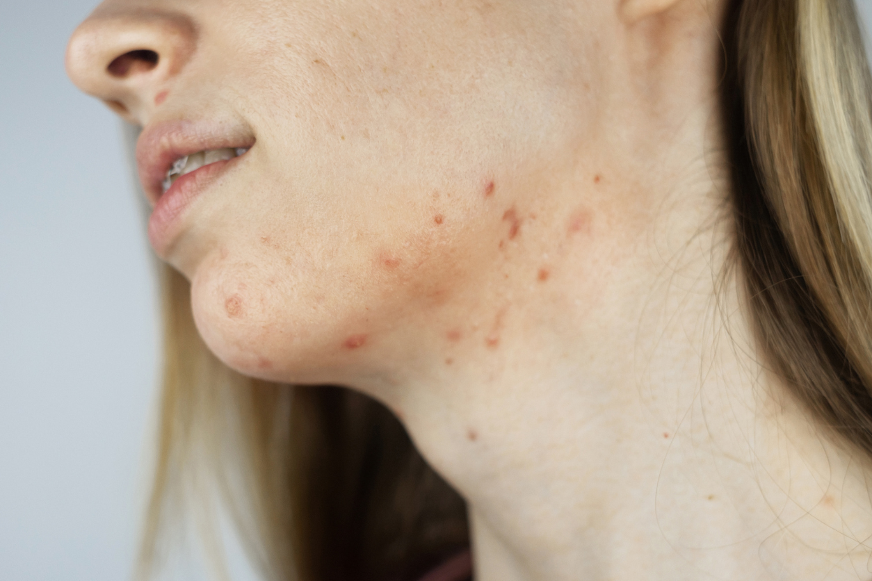 fungal vs hormonal acne