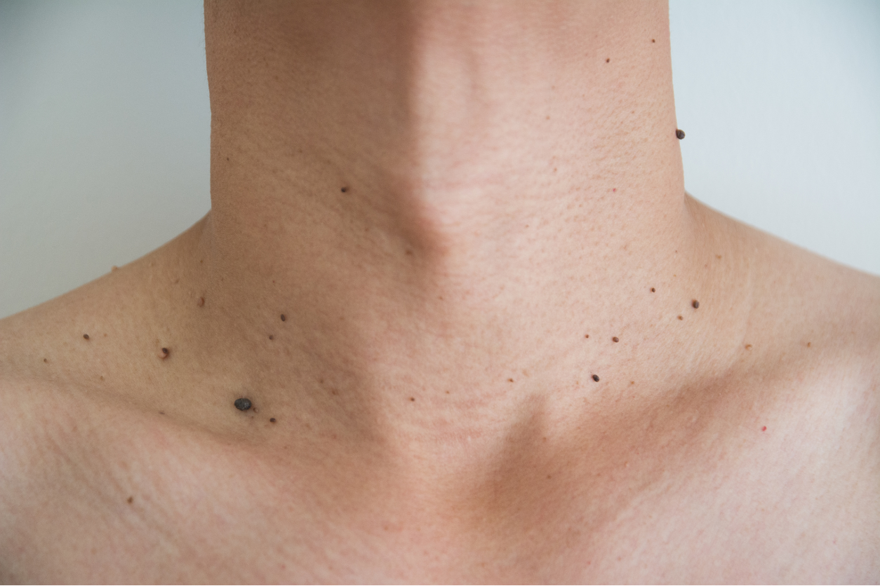 Freezing Skin Tags