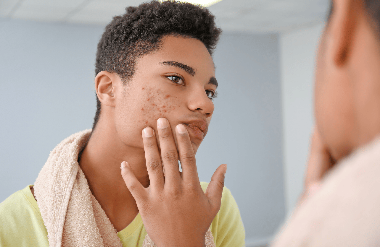 does creatine cause acne